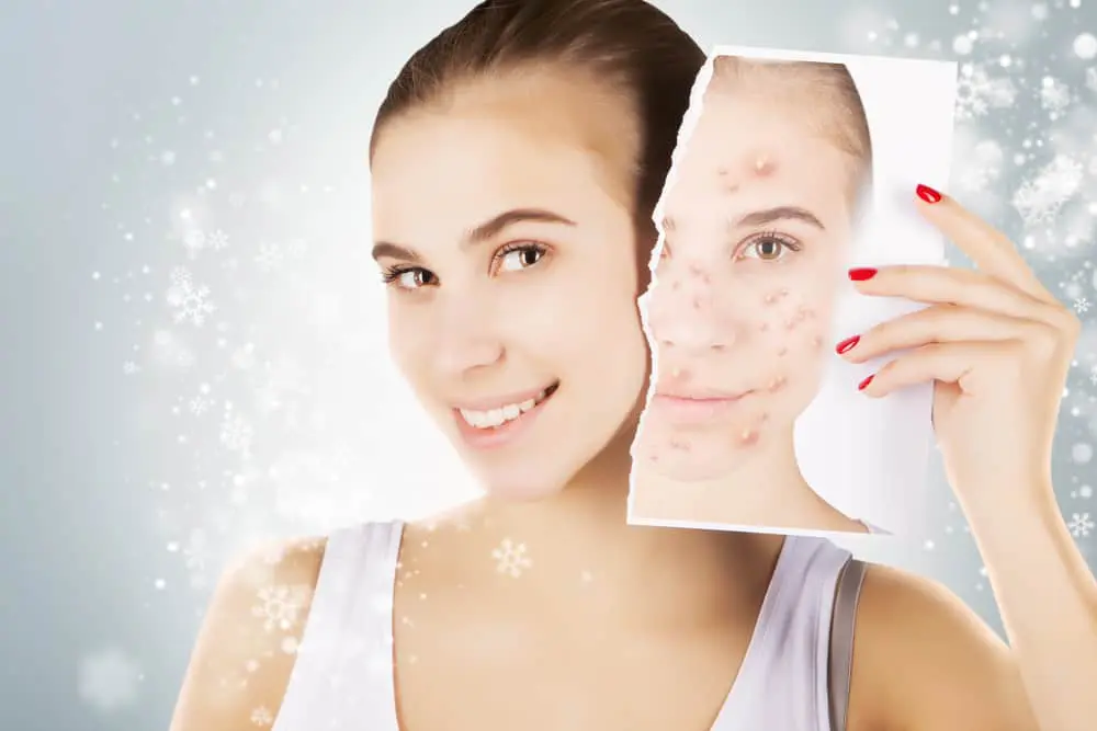 acne-prone-skin