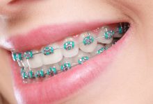 Metal Braces for Kids: Enhancing Smiles with Confidence